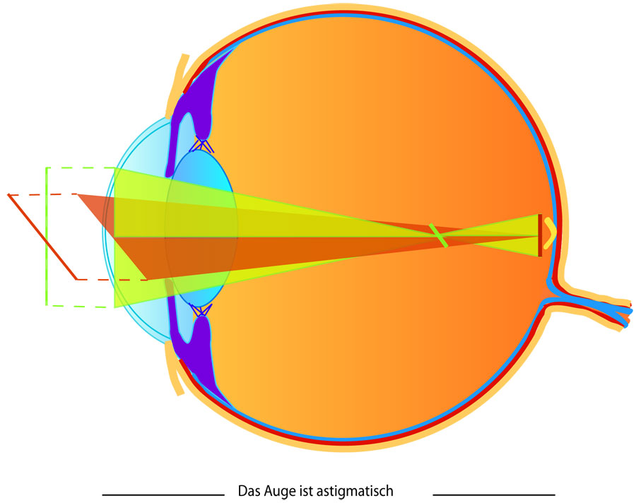 astigmatisches Auge